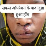 बीजापुर जिला अस्पताल में सफल क्लेफ्ट लिप सर्जरी: 22 साल बाद भीमे हेमला के चेहरे पर लौटी मुस्कान