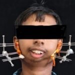 आयुष्मान योजना से मिला नया जीवन: सिम्स में जटिल सर्जरी से 24 वर्षीय युवक का वर्षों पुराना बंद जबड़ा खुला